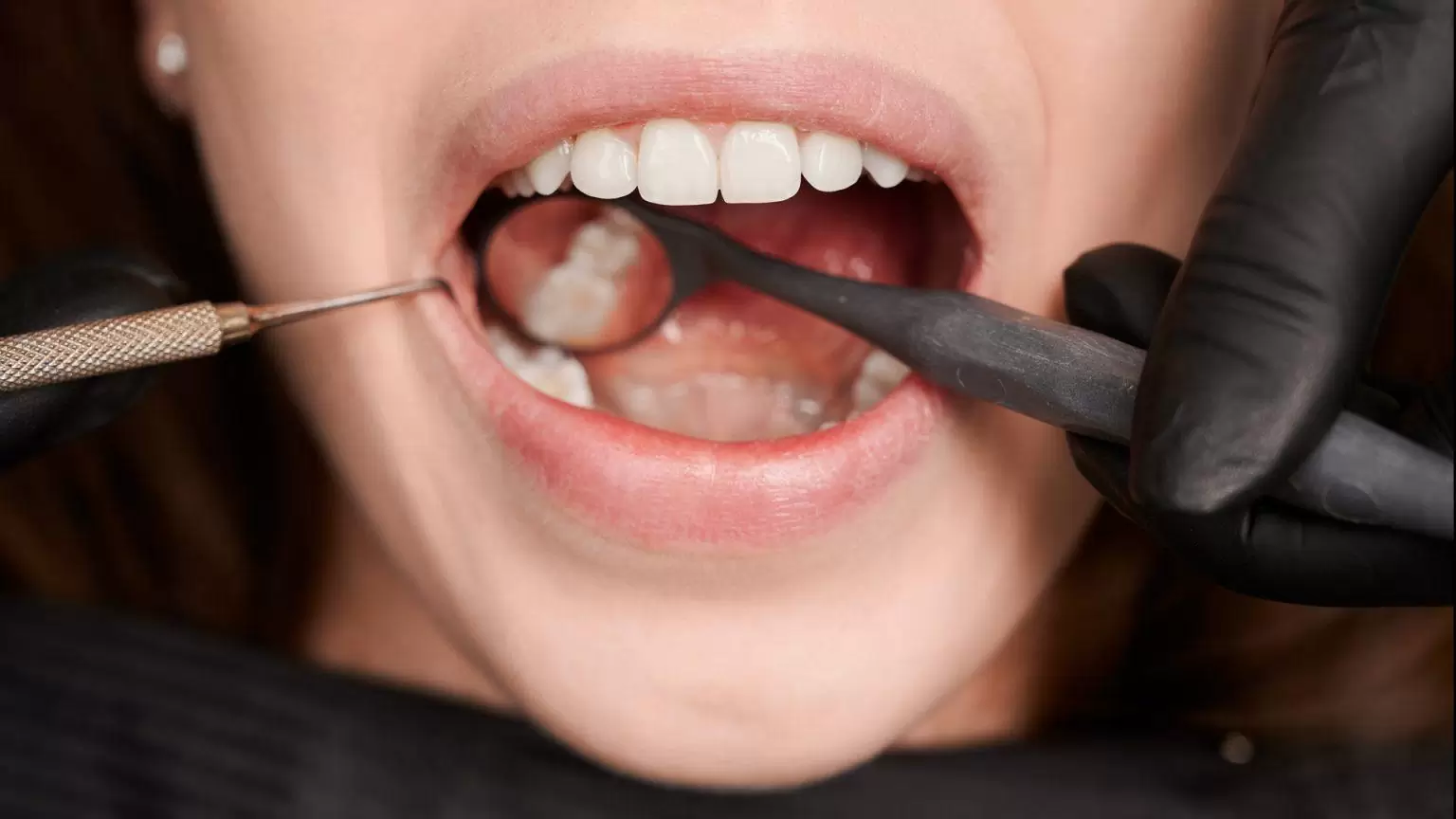 Diş Etlerinde Büyüme Nedir? Tedavisi Var mı?