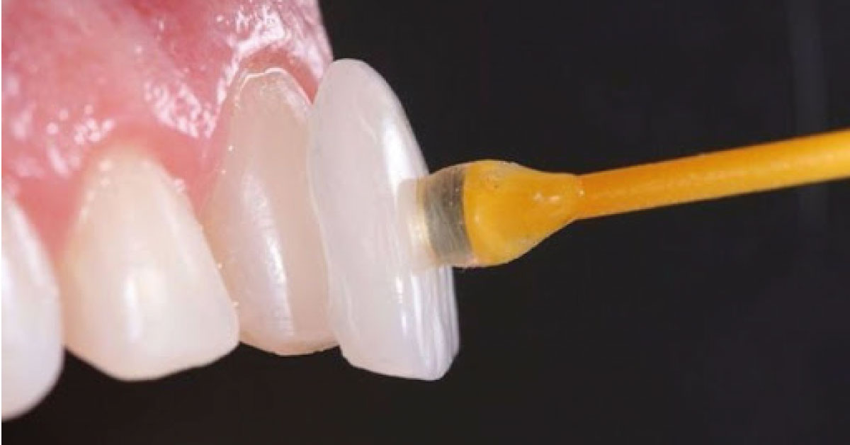 Lamina Yaprak Porselen